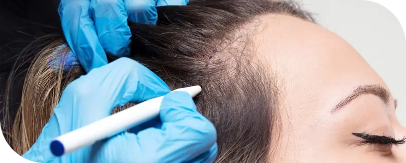 Hair Transplant For Women In Turkey